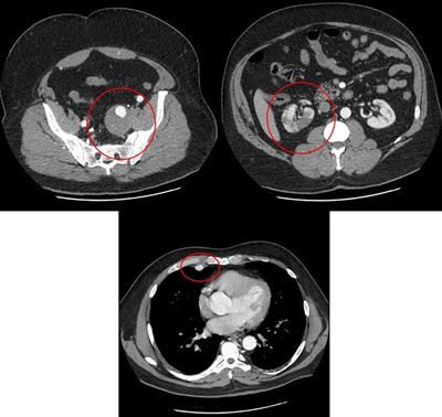 De novo heterozygous pathogenic FBN1 variant in an autopsy case of multiple aneurysms and right renal artery dissection: a case report